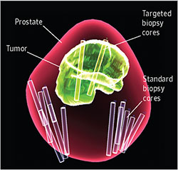 Fusion Biopsy graphic