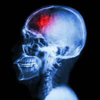 Neuro skull xray