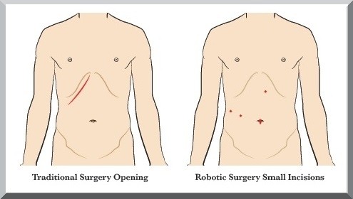 Traditional surgery and Robotic surgery incision comparison